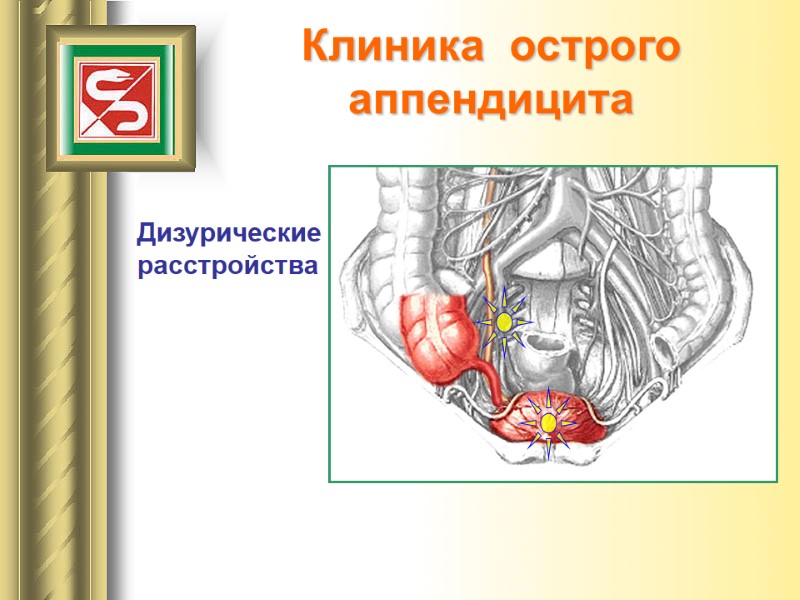 Клиника  острого  аппендицита Дизурические расстройства